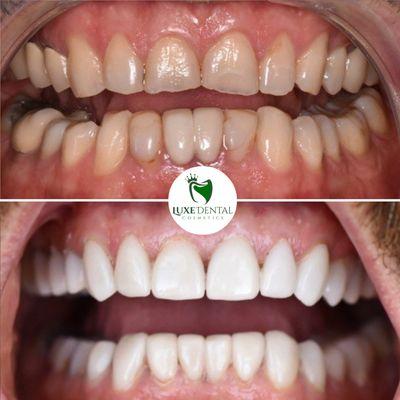 Full Smile Makeover with a combination of crowns and veneers, a total of 24 restorations