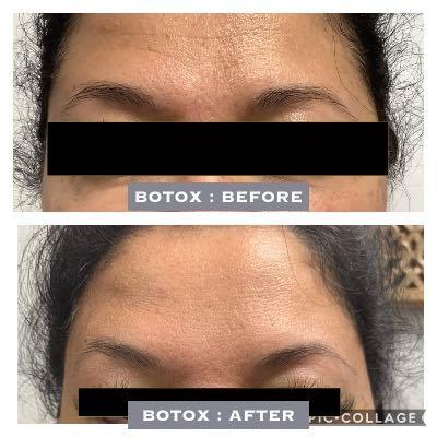 Botox Treatment : Before and After