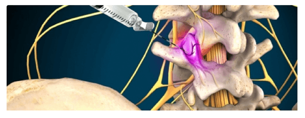 Diagnostic Medial Branch Block - A facet joint is the point between vertebrae that allows the spine to twist and bend...