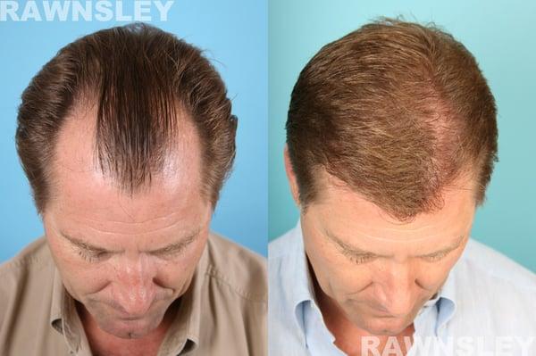 Hair Transplant Before & After | Rawnsley Hair Restoration