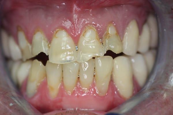 Before photo showing severe wear and old failing fillings.