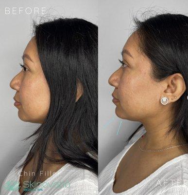 Our patient just wanted a touch of filler, @carol_skinovatio gave her just that on her chin