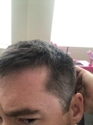 Random chunk taken out of hairline