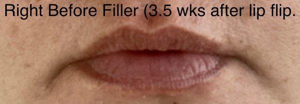 Botox lip flip lasts 1 to 2 months and is cheap... Please do not expect it to take the place of lip fillers!!