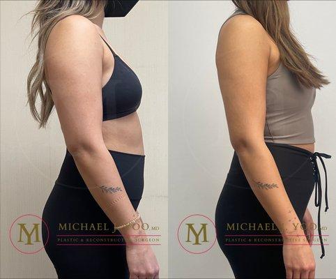 Upper Arm & Posterior Axillary Liposuction by Dr. Michael J. Yoo, MD - Double Board Certified Plastic Surgeon