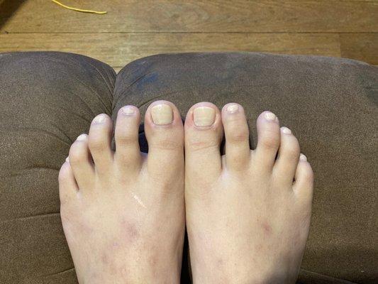 my toes after 2 days