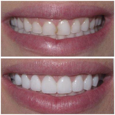 Are you interested in veneers? Visit our office for a complimentary consultation.