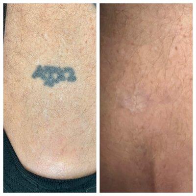 Tattoo removal