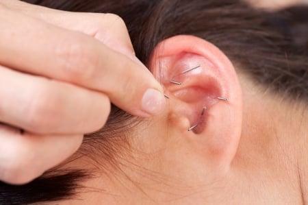 Auricular Acupuncture Treatment