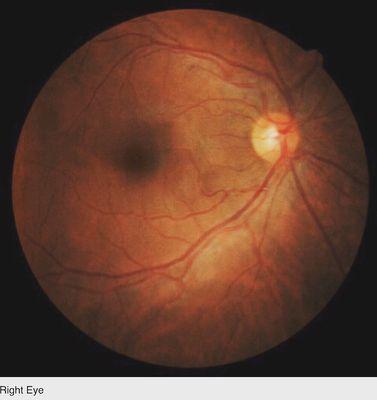 My right eye! (Retinal photograph by Dr. Richard Eisenberg)