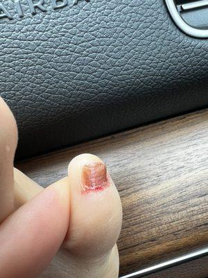 Bleeding cuticle