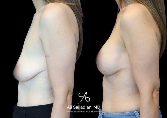 Before and After | Breast Augmentation and Lift