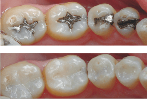 Tooth Colored Fillings