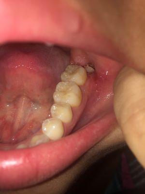 Part of my tooth still in there lmao sorry this is a gross photo