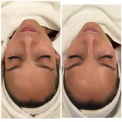 Facials By Brittany here at studio 841 I offer The Hydrafacial, Chemical Peels, Microdermabrasion, Facial massaged, waxing and more.