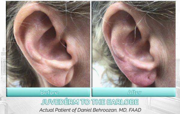 Juvederm can be used for non-surgical earlobe repair to reverse years of pulling and pressure from heavy earrings & piercings.