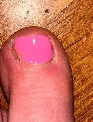 Infected toe