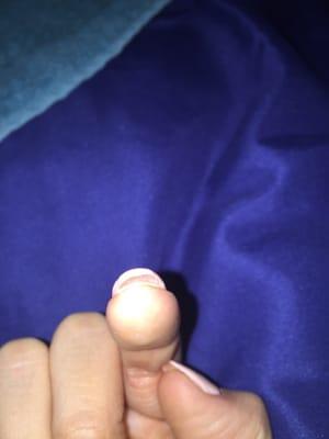 Separation from nail