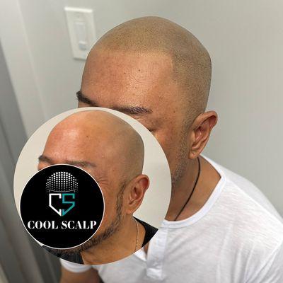 Complete hairline restoration