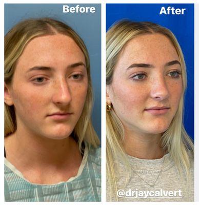 Rhinoplasty (primary) by Dr Jay Calvert from Beverly Hills, California