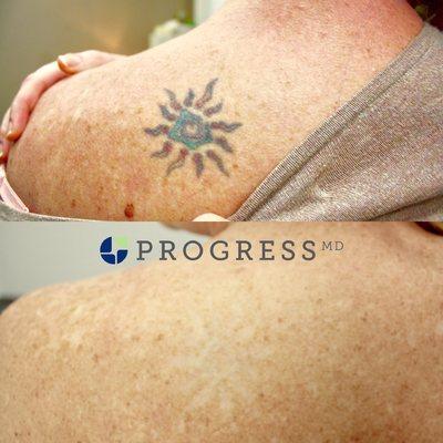 Successful Laser Tattoo Removal Patient Before and After - Lumenis PiQo4 Nano and Pico Q-Switch Tattoo Removal - Happy Patient!