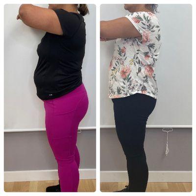 Before and After Semaglutide Weight-loss injections