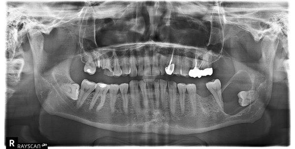 Before the wisdom tooth was removed on the right side of the pic