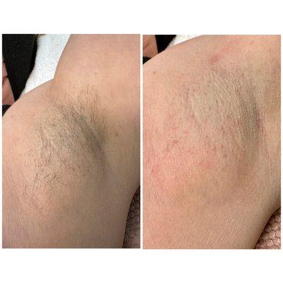 Before & After underarm wax