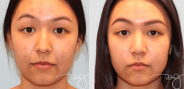 Rhinoplasty