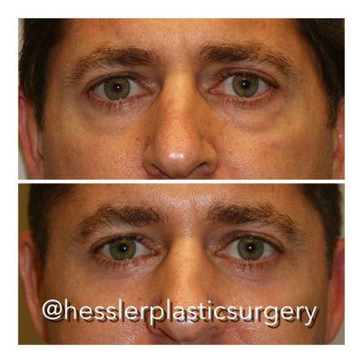 This kind gentleman was tired of people asking him if he was tired. He underwent a lower eyelid blepharoplasty& laser resurfacing.