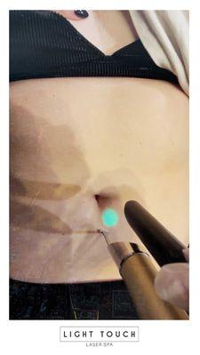 Stomach laser hair removal - Light Touch Laser Spa NYC