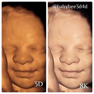 Baby Bee 3D Ultrasound (Fort Worth)