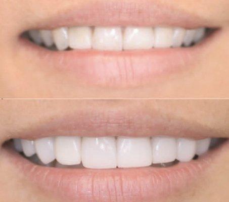 With Porcelain Veneers we transformed the smile to a wider fuller and brighter smile