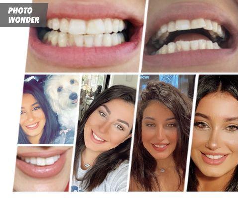 Straighten and whitening done by Dr. Abbassi. (Took 6 months only!)