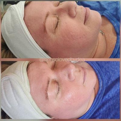 Ultra Hydration facial