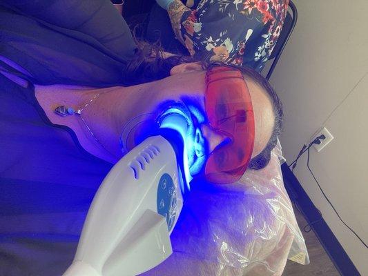 Teeth whitening