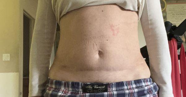 AFTER: This is all that he left if my belly. Check out before pics and picks of scars after first surgery. NOT AN IMPROVEMENT!!!