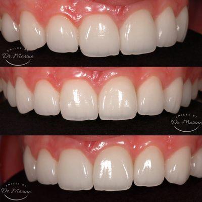 Beautiful porcelain veneers. We mastered the  most esthetic technique in creating stunning porcelain veneers.