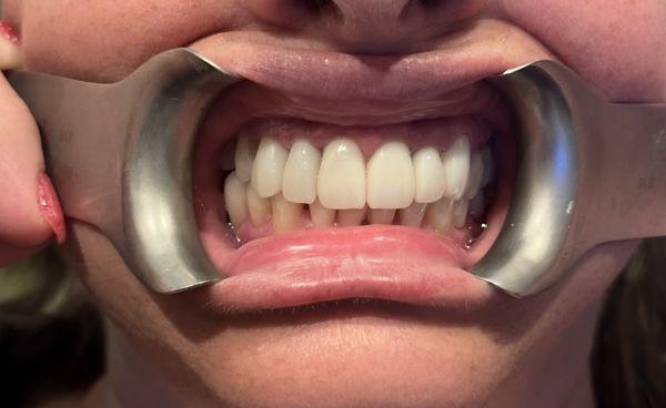 New porcelain crowns after teeth whitening, amazing results