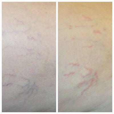 Spider Vein Removal Treatments. Before and immediately after