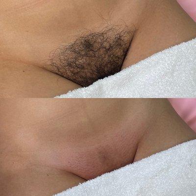 Brazilian Wax before and after