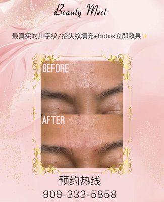 Filler to smooth out wrinkles 
Before and right After  results are amazing