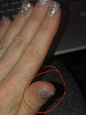 Thumb nail completely broke off after 4 days