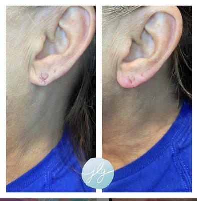 Ear lobe filler for all of us who wore heavy earrings growing up!