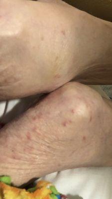 Bites in my moms legs from scabies....