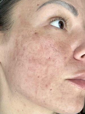 Hyperpigmentation following procedure