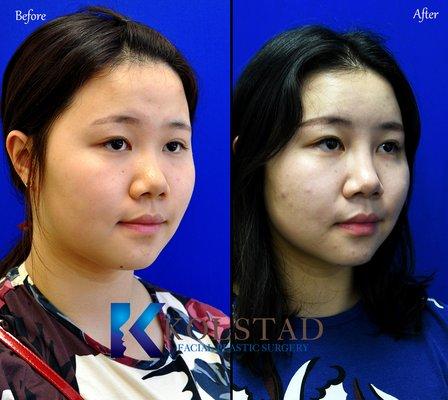 liquid rhinoplasty