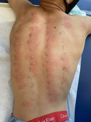 13 year old son allergy testing