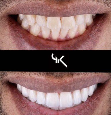 10 Porcelain Veneers + Zoom Whitening!