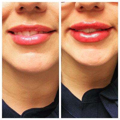 Versa lip filler